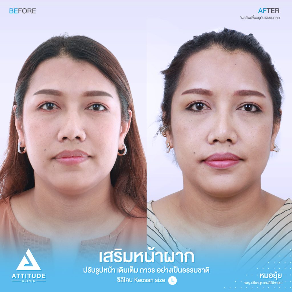รีวิวเสริมหน้าผากด้วยซิลิโคนสำเร็จ Keosan size L ของคุณมล แก้ปัญหาหน้าผากค่อนข้างแบน โหนกคิ้วสูง โดยหมอยุ้ย ที่ Attitude Clinic รัชดา คุณมล ได้รับเข้าปรึกษากับคุณหมอยุ้ยก่อนเข้ารับการผ่าตัด ปัญหาของคุณมล มีหน้าผากไม่เรียบบางจุด สามารถปรับเหลาตัวซิลิโคนได้ และบริเวณหางคิ้ว ไม่ได้บุ๋มเยอะ สามารถใช้ซิลิโคนสำเร็จ และปรับเหลาได้