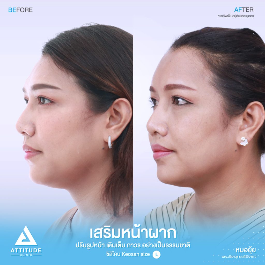 รีวิวเสริมหน้าผากด้วยซิลิโคนสำเร็จ Keosan size L ของคุณมล แก้ปัญหาหน้าผากค่อนข้างแบน โหนกคิ้วสูง โดยหมอยุ้ย ที่ Attitude Clinic รัชดา คุณมล ได้รับเข้าปรึกษากับคุณหมอยุ้ยก่อนเข้ารับการผ่าตัด ปัญหาของคุณมล มีหน้าผากไม่เรียบบางจุด สามารถปรับเหลาตัวซิลิโคนได้ และบริเวณหางคิ้ว ไม่ได้บุ๋มเยอะ สามารถใช้ซิลิโคนสำเร็จ และปรับเหลาได้