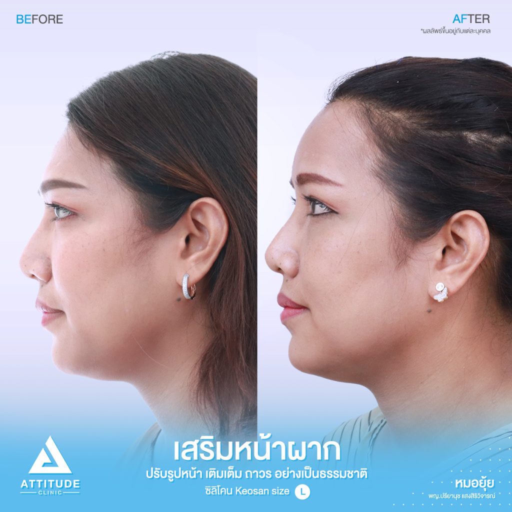 รีวิวเสริมหน้าผากด้วยซิลิโคนสำเร็จ Keosan size L ของคุณมล แก้ปัญหาหน้าผากค่อนข้างแบน โหนกคิ้วสูง โดยหมอยุ้ย ที่ Attitude Clinic รัชดา คุณมล ได้รับเข้าปรึกษากับคุณหมอยุ้ยก่อนเข้ารับการผ่าตัด ปัญหาของคุณมล มีหน้าผากไม่เรียบบางจุด สามารถปรับเหลาตัวซิลิโคนได้ และบริเวณหางคิ้ว ไม่ได้บุ๋มเยอะ สามารถใช้ซิลิโคนสำเร็จ และปรับเหลาได้