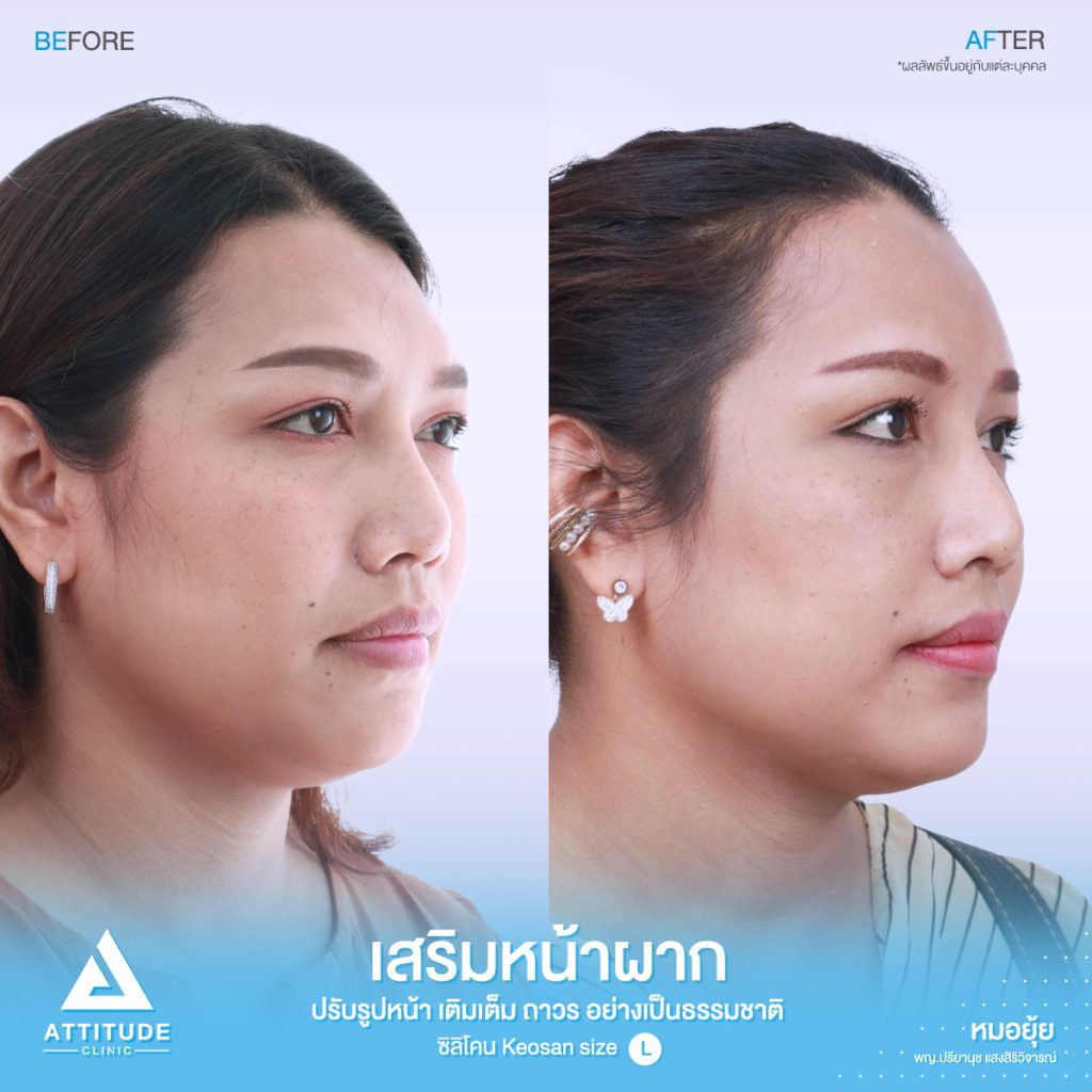 รีวิวเสริมหน้าผากด้วยซิลิโคนสำเร็จ Keosan size L ของคุณมล แก้ปัญหาหน้าผากค่อนข้างแบน โหนกคิ้วสูง โดยหมอยุ้ย ที่ Attitude Clinic รัชดา คุณมล ได้รับเข้าปรึกษากับคุณหมอยุ้ยก่อนเข้ารับการผ่าตัด ปัญหาของคุณมล มีหน้าผากไม่เรียบบางจุด สามารถปรับเหลาตัวซิลิโคนได้ และบริเวณหางคิ้ว ไม่ได้บุ๋มเยอะ สามารถใช้ซิลิโคนสำเร็จ และปรับเหลาได้
