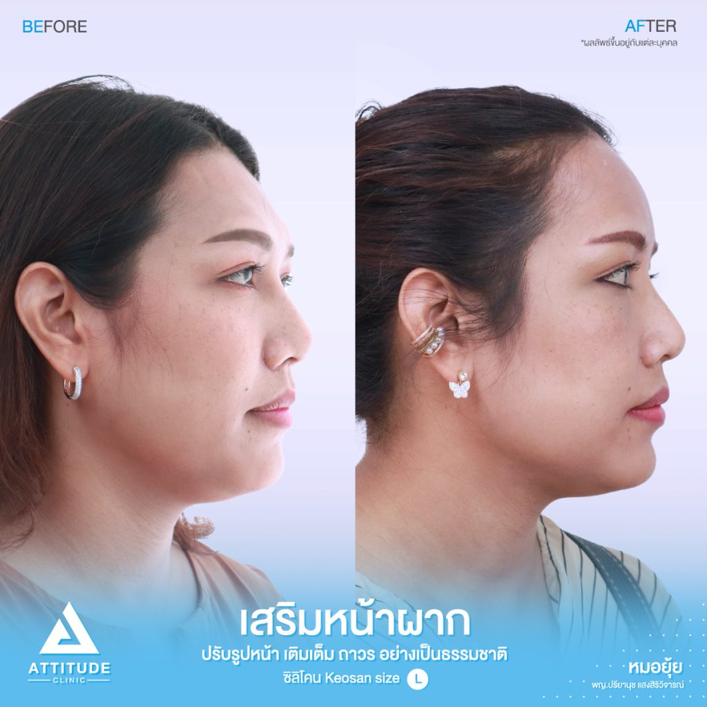 รีวิวเสริมหน้าผากด้วยซิลิโคนสำเร็จ Keosan size L ของคุณมล แก้ปัญหาหน้าผากค่อนข้างแบน โหนกคิ้วสูง โดยหมอยุ้ย ที่ Attitude Clinic รัชดา คุณมล ได้รับเข้าปรึกษากับคุณหมอยุ้ยก่อนเข้ารับการผ่าตัด ปัญหาของคุณมล มีหน้าผากไม่เรียบบางจุด สามารถปรับเหลาตัวซิลิโคนได้ และบริเวณหางคิ้ว ไม่ได้บุ๋มเยอะ สามารถใช้ซิลิโคนสำเร็จ และปรับเหลาได้