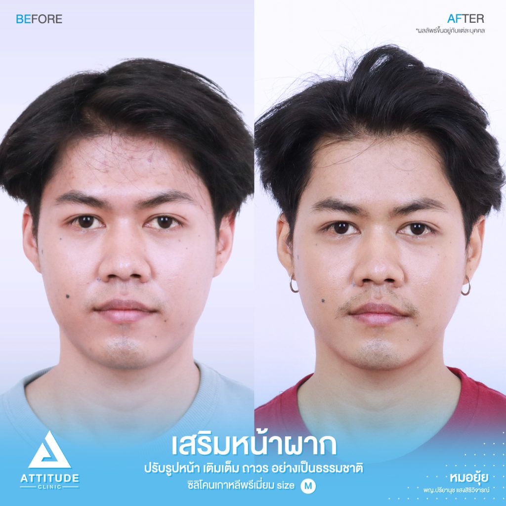 รีวิวเสริมหน้าผากผู้ชาย ด้วยซิลิโคนพรีเมียมสำเร็จ Size M แก้ปัญหาหน้าผากเป็นแอ่ง โดยหมอยุ้ย Attitude Clinic รัชดา คุณเชน มีปัญหาเรื่องหน้าผาก เดิมมีโหนกคิ้วค่อยข้างสูง เลยทำให้บริเวณหน้าผากเป็นแอ่ง ดูยุบลงไปค่อนข้างเยอะ ทำให้รูปหน้าไม่สมดุล และไม่อวบอิ่ม