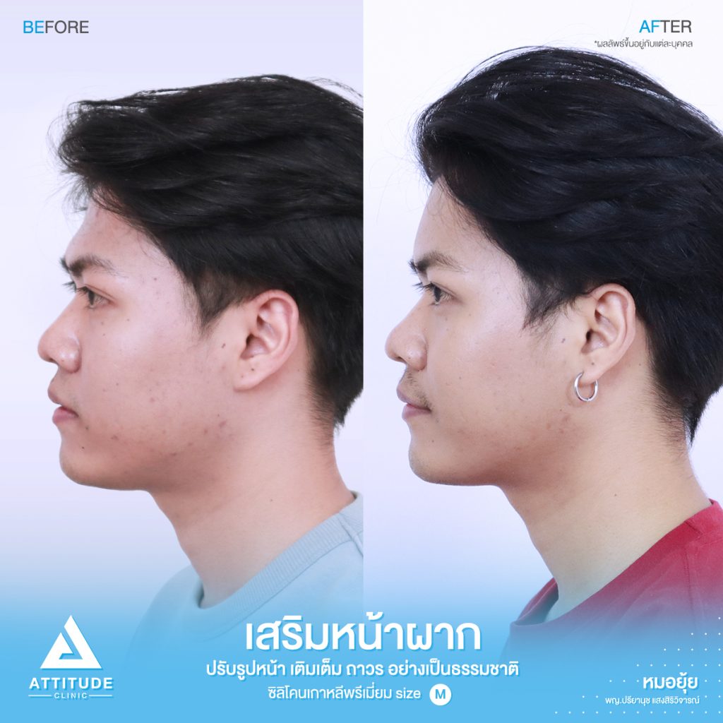 รีวิวเสริมหน้าผากผู้ชาย ด้วยซิลิโคนพรีเมียมสำเร็จ Size M แก้ปัญหาหน้าผากเป็นแอ่ง โดยหมอยุ้ย Attitude Clinic รัชดา คุณเชน มีปัญหาเรื่องหน้าผาก เดิมมีโหนกคิ้วค่อยข้างสูง เลยทำให้บริเวณหน้าผากเป็นแอ่ง ดูยุบลงไปค่อนข้างเยอะ ทำให้รูปหน้าไม่สมดุล และไม่อวบอิ่ม
