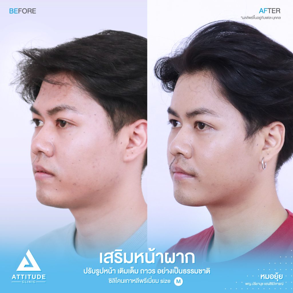 รีวิวเสริมหน้าผากผู้ชาย ด้วยซิลิโคนพรีเมียมสำเร็จ Size M แก้ปัญหาหน้าผากเป็นแอ่ง โดยหมอยุ้ย Attitude Clinic รัชดา คุณเชน มีปัญหาเรื่องหน้าผาก เดิมมีโหนกคิ้วค่อยข้างสูง เลยทำให้บริเวณหน้าผากเป็นแอ่ง ดูยุบลงไปค่อนข้างเยอะ ทำให้รูปหน้าไม่สมดุล และไม่อวบอิ่ม