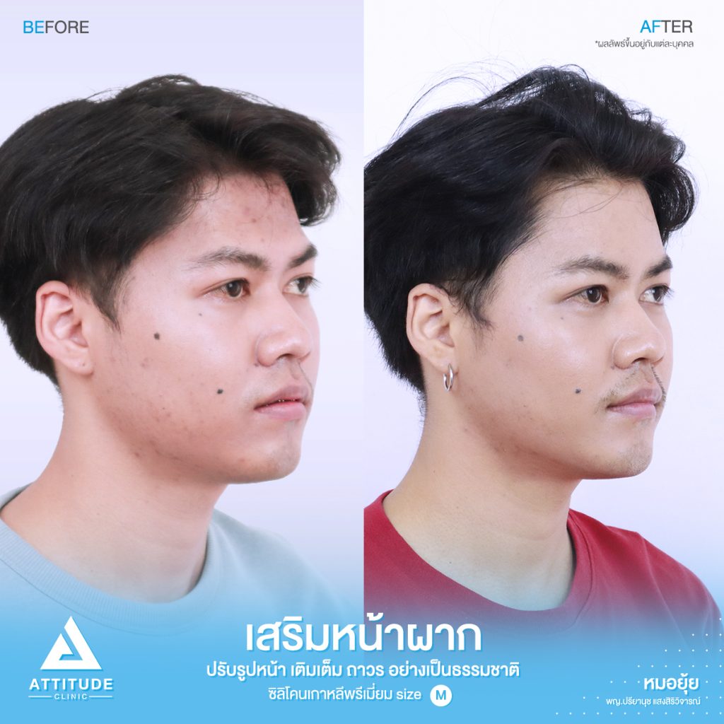 รีวิวเสริมหน้าผากผู้ชาย ด้วยซิลิโคนพรีเมียมสำเร็จ Size M แก้ปัญหาหน้าผากเป็นแอ่ง โดยหมอยุ้ย Attitude Clinic รัชดา คุณเชน มีปัญหาเรื่องหน้าผาก เดิมมีโหนกคิ้วค่อยข้างสูง เลยทำให้บริเวณหน้าผากเป็นแอ่ง ดูยุบลงไปค่อนข้างเยอะ ทำให้รูปหน้าไม่สมดุล และไม่อวบอิ่ม