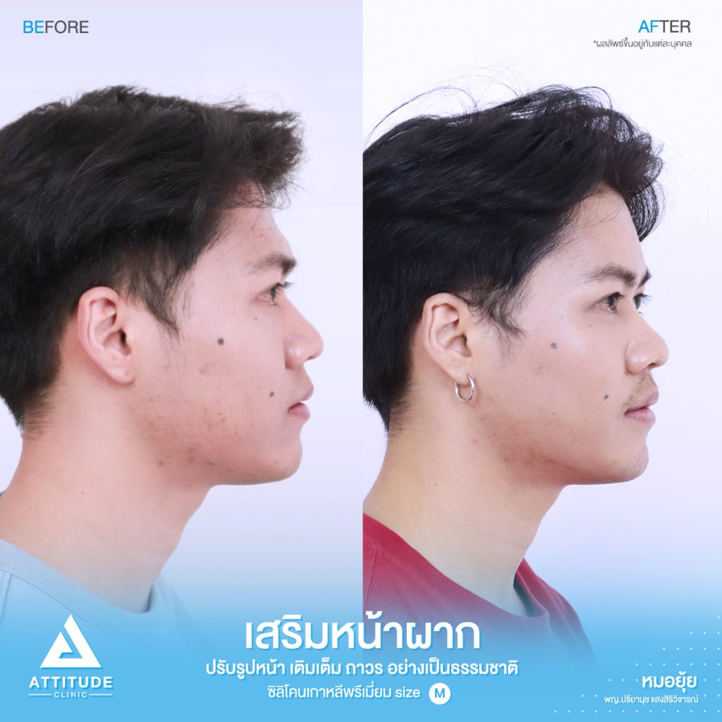 รีวิวเสริมหน้าผากผู้ชาย ด้วยซิลิโคนพรีเมียมสำเร็จ Size M แก้ปัญหาหน้าผากเป็นแอ่ง โดยหมอยุ้ย Attitude Clinic รัชดา คุณเชน มีปัญหาเรื่องหน้าผาก เดิมมีโหนกคิ้วค่อยข้างสูง เลยทำให้บริเวณหน้าผากเป็นแอ่ง ดูยุบลงไปค่อนข้างเยอะ ทำให้รูปหน้าไม่สมดุล และไม่อวบอิ่ม