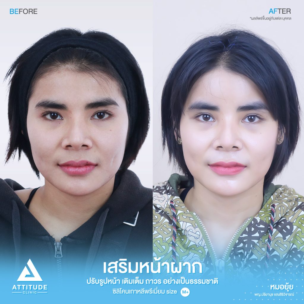 รีวิวเสริมหน้าผาก ด้วยซิลิโคนพรีเมียมสำเร็จ Size M ปรับรูปหน้าเติมเต็มให้อวบอิ่มมากขึ้น โดยหมอยุ้ย Attitude Clinic รัชดา คุณพิมพ์ มีปัญหาจากฐานกระดูกเดิม โครงสร้าง หน้าผากแบนราบ และรูปหน้า หน้าผากแคบ ทำให้ใบหน้าไม่มีมิติ ดูแข็งทื่อ