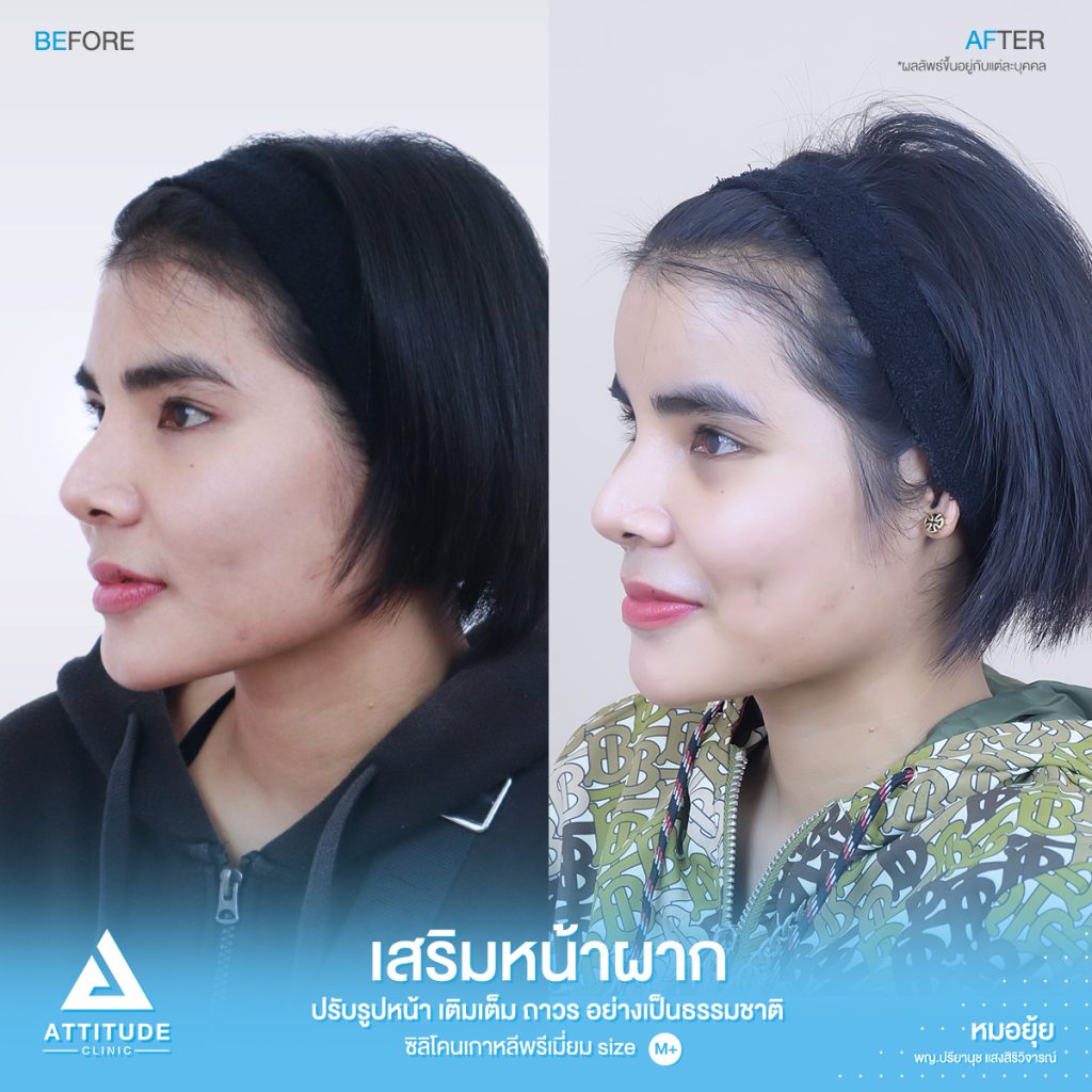 รีวิวเสริมหน้าผาก ด้วยซิลิโคนพรีเมียมสำเร็จ Size M ปรับรูปหน้าเติมเต็มให้อวบอิ่มมากขึ้น โดยหมอยุ้ย Attitude Clinic รัชดา  คุณพิมพ์ มีปัญหาจากฐานกระดูกเดิม โครงสร้าง หน้าผากแบนราบ และรูปหน้า หน้าผากแคบ ทำให้ใบหน้าไม่มีมิติ ดูแข็งทื่อ 