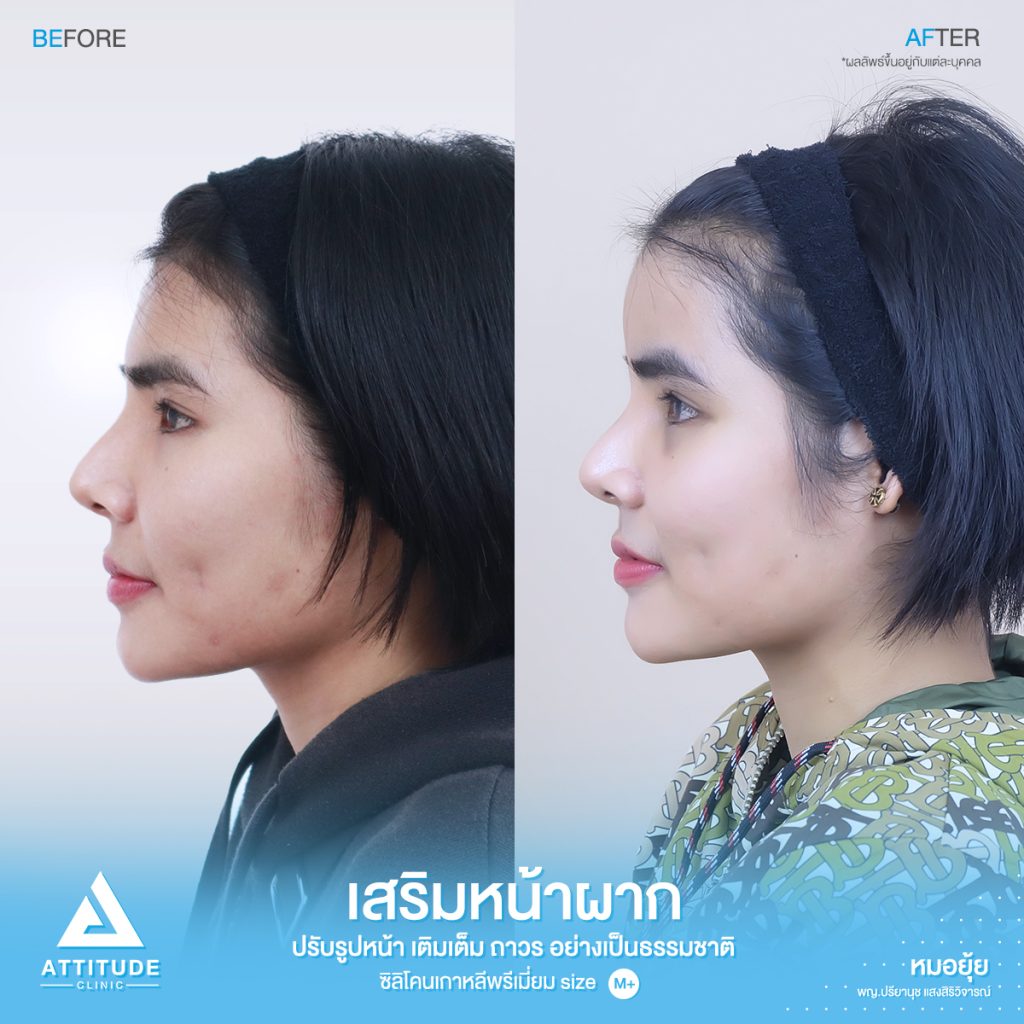 รีวิวเสริมหน้าผาก ด้วยซิลิโคนพรีเมียมสำเร็จ Size M ปรับรูปหน้าเติมเต็มให้อวบอิ่มมากขึ้น โดยหมอยุ้ย Attitude Clinic รัชดา  คุณพิมพ์ มีปัญหาจากฐานกระดูกเดิม โครงสร้าง หน้าผากแบนราบ และรูปหน้า หน้าผากแคบ ทำให้ใบหน้าไม่มีมิติ ดูแข็งทื่อ 