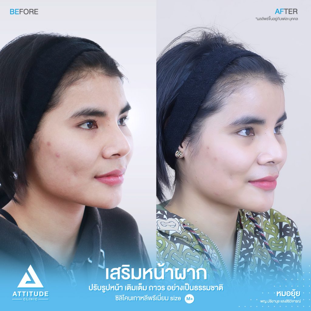 รีวิวเสริมหน้าผาก ด้วยซิลิโคนพรีเมียมสำเร็จ Size M ปรับรูปหน้าเติมเต็มให้อวบอิ่มมากขึ้น โดยหมอยุ้ย Attitude Clinic รัชดา  คุณพิมพ์ มีปัญหาจากฐานกระดูกเดิม โครงสร้าง หน้าผากแบนราบ และรูปหน้า หน้าผากแคบ ทำให้ใบหน้าไม่มีมิติ ดูแข็งทื่อ 