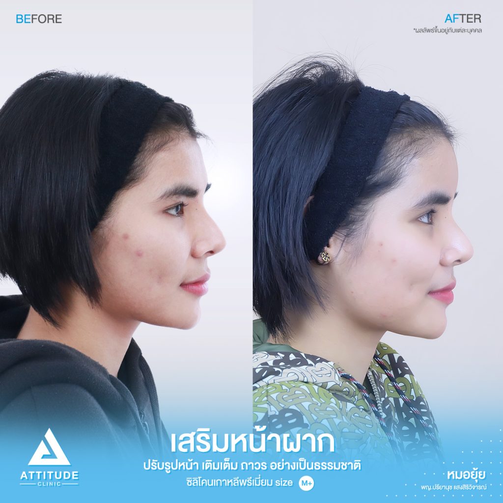 รีวิวเสริมหน้าผาก ด้วยซิลิโคนพรีเมียมสำเร็จ Size M ปรับรูปหน้าเติมเต็มให้อวบอิ่มมากขึ้น โดยหมอยุ้ย Attitude Clinic รัชดา  คุณพิมพ์ มีปัญหาจากฐานกระดูกเดิม โครงสร้าง หน้าผากแบนราบ และรูปหน้า หน้าผากแคบ ทำให้ใบหน้าไม่มีมิติ ดูแข็งทื่อ 