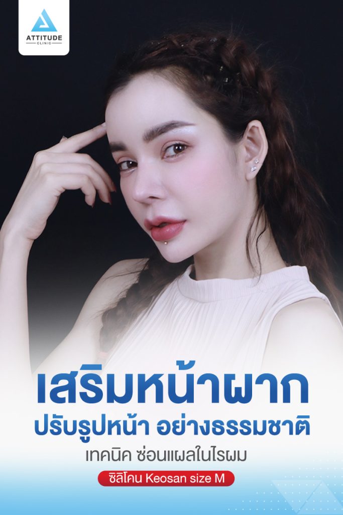 รีวิวเสริมหน้าผากด้วยซิลิโคนแบบสำเร็จ Keosan size M ปรับรูปหน้าเติมเต็มให้อวบอิ่มมากขึ้น โดยหมอยุ้ย Attitude Clinic รัชดา คุณอลิช ก่อนทำหน้าผากมีอยู่แล้ว แต่ต้องการความนูนเพิ่ม เพื่อให้รับกับจมูก แต่ยังต้องการความนูนที่พอดี และเป็นธรรมชาติ