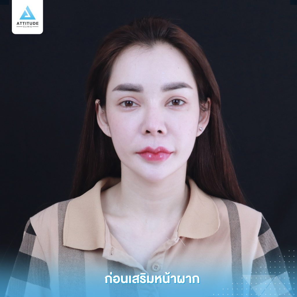 รีวิวเสริมหน้าผากด้วยซิลิโคนแบบสำเร็จ Keosan size M ปรับรูปหน้าเติมเต็มให้อวบอิ่มมากขึ้น โดยหมอยุ้ย Attitude Clinic รัชดา คุณอลิช ก่อนทำหน้าผากมีอยู่แล้ว แต่ต้องการความนูนเพิ่ม เพื่อให้รับกับจมูก แต่ยังต้องการความนูนที่พอดี และเป็นธรรมชาติ