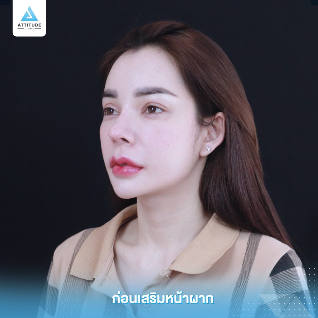 รีวิวเสริมหน้าผากด้วยซิลิโคนแบบสำเร็จ Keosan size M ปรับรูปหน้าเติมเต็มให้อวบอิ่มมากขึ้น โดยหมอยุ้ย Attitude Clinic รัชดา คุณอลิช ก่อนทำหน้าผากมีอยู่แล้ว แต่ต้องการความนูนเพิ่ม เพื่อให้รับกับจมูก แต่ยังต้องการความนูนที่พอดี และเป็นธรรมชาติ