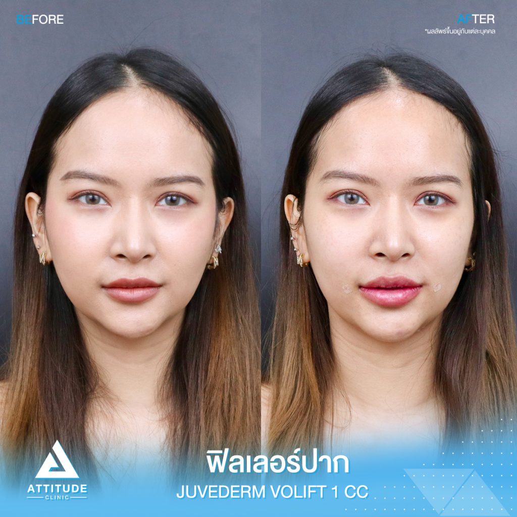 รีวิวฉีดฟิลเลอร์ปาก Juvederm Volift จำนวน 1 cc เติมเต็มปรับรูปปากให้สวยอวบอิ่ม ปากดูเต็มเป็นธรรมชาติที่ Attitude Clinic ฟิลเลอร์ปากเชียงราย ฟิลเลอร์ปากเชียงใหม่ ฟิลเลอร์ปากลำปาง หมออยู่ทุกวัน ทำเองทุกเคส รีวิวเยอะที่สุด