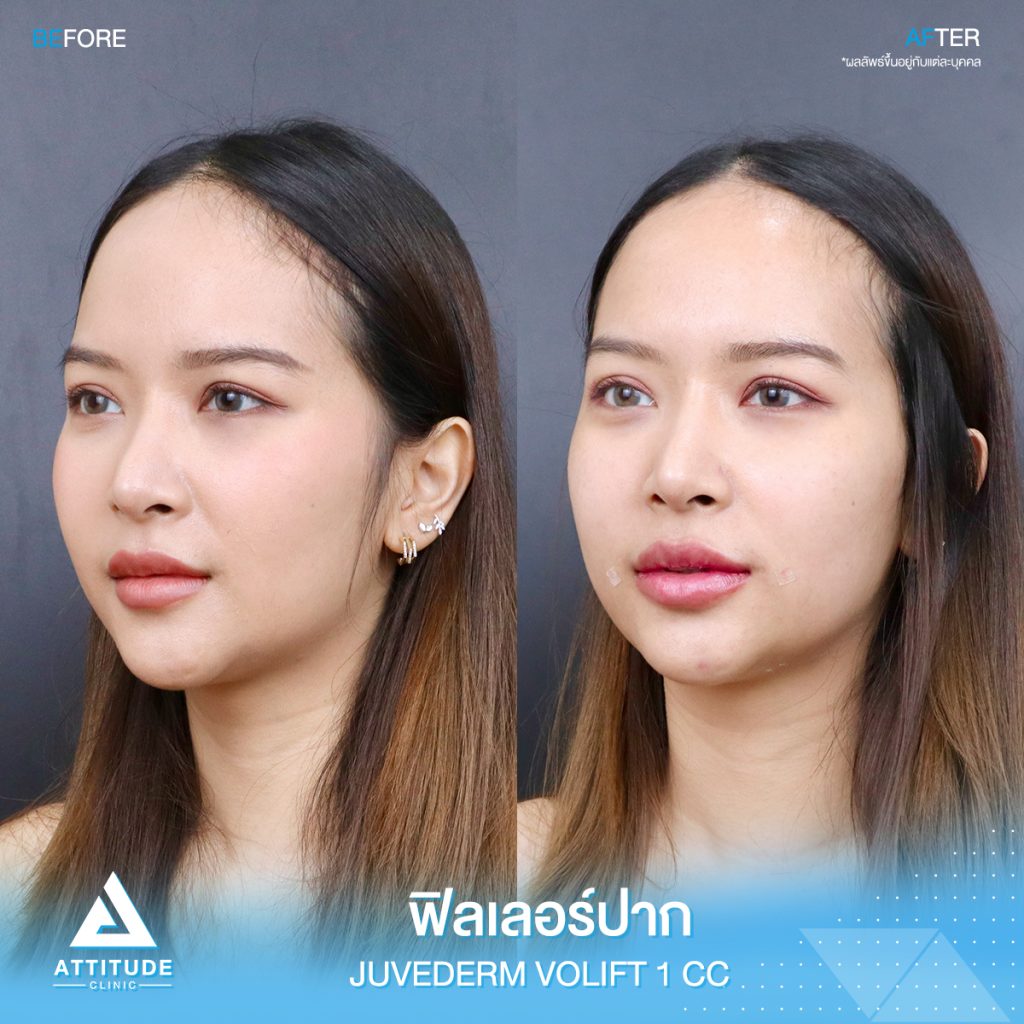 รีวิวฉีดฟิลเลอร์ปาก Juvederm Volift จำนวน 1 cc เติมเต็มปรับรูปปากให้สวยอวบอิ่ม ปากดูเต็มเป็นธรรมชาติที่ Attitude Clinic ฟิลเลอร์ปากเชียงราย ฟิลเลอร์ปากเชียงใหม่ ฟิลเลอร์ปากลำปาง หมออยู่ทุกวัน ทำเองทุกเคส รีวิวเยอะที่สุด