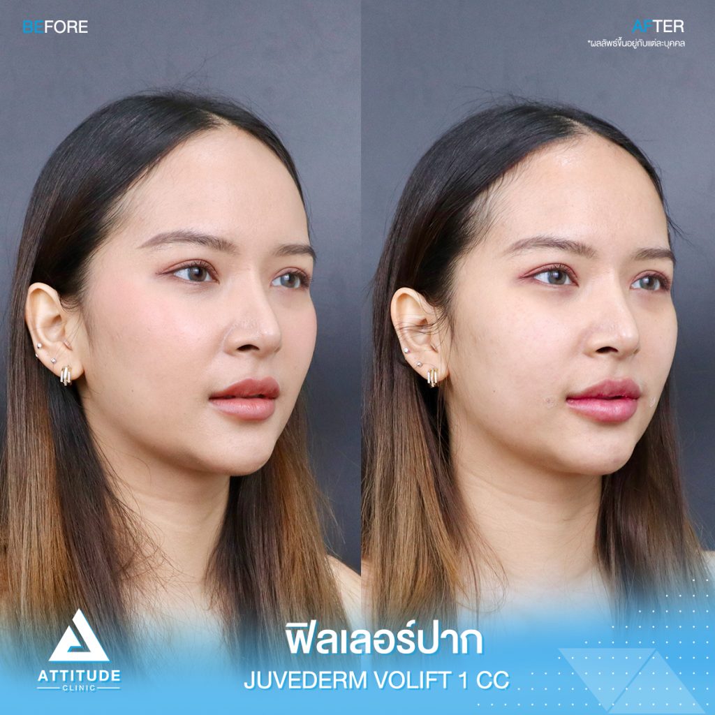 รีวิวฉีดฟิลเลอร์ปาก Juvederm Volift จำนวน 1 cc เติมเต็มปรับรูปปากให้สวยอวบอิ่ม ปากดูเต็มเป็นธรรมชาติที่ Attitude Clinic ฟิลเลอร์ปากเชียงราย ฟิลเลอร์ปากเชียงใหม่ ฟิลเลอร์ปากลำปาง หมออยู่ทุกวัน ทำเองทุกเคส รีวิวเยอะที่สุด