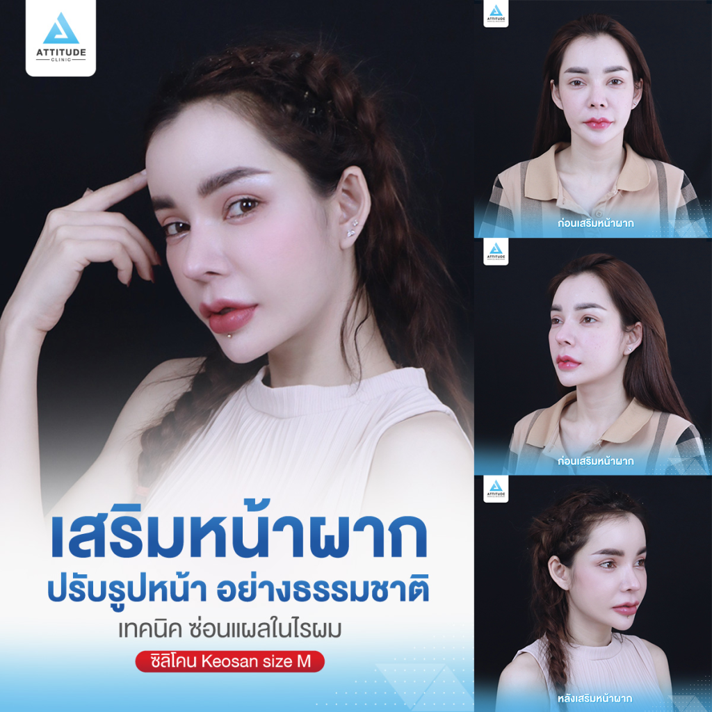 รีวิวเสริมหน้าผากด้วยซิลิโคนแบบสำเร็จ Keosan size M ปรับรูปหน้าเติมเต็มให้อวบอิ่มมากขึ้น โดยหมอยุ้ย Attitude Clinic รัชดา คุณอลิช ก่อนทำหน้าผากมีอยู่แล้ว แต่ต้องการความนูนเพิ่ม เพื่อให้รับกับจมูก แต่ยังต้องการความนูนที่พอดี และเป็นธรรมชาติ