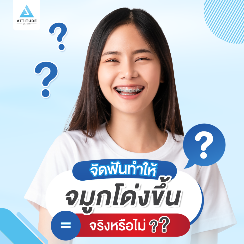 จัดฟันทำให้จมูกโด่งขึ้นจริงหรือไม่? หมอยุ้ย จาก Attitude Clinic รัชดา มีคำตอบข้อ เท็จจริงของการจัดฟัน คือ การใส่เครื่องมือจัดฟันเพื่อเคลื่อนฟันไปยังตำแหน่งที่เหมาะสมตามรูปปากของแต่ละคน ดังนั้นการจัดฟันไม่ช่วยให้จมูกโด่งขึ้นแต่อย่างใด!!
