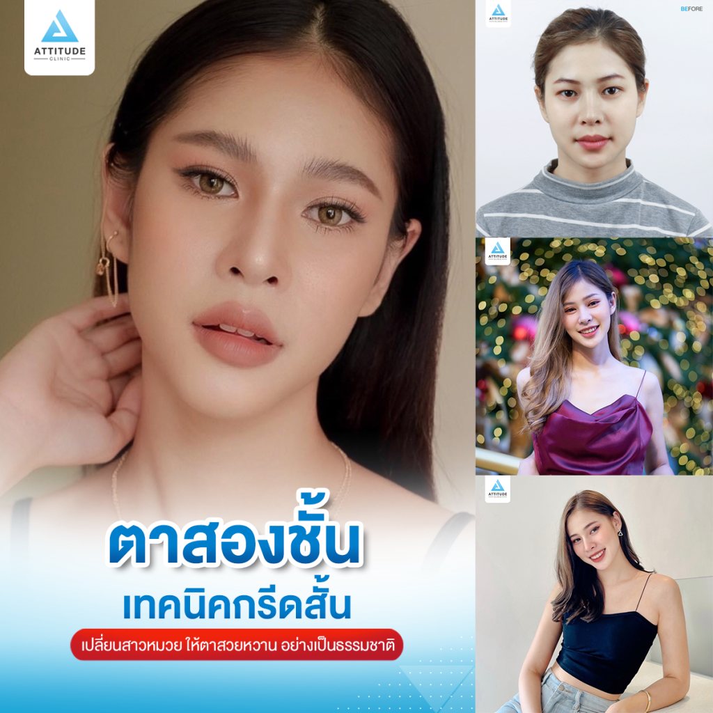 รีวิวทำตาสองชั้น แบบกรีดสั้น