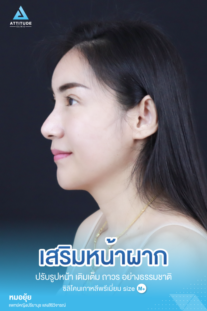 รีวิวเสริมหน้าผากผู้หญิง ด้วยซิลิโคน สำเร็จ เกาหลีพรีเมียม size M แก้ปัญหาหน้าผากแบน ให้สวยมีมิติ โดยคุณหมอยุ้ย Attitude Clinic เชียงราย