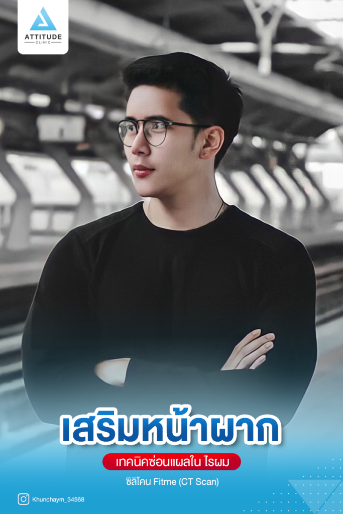 รีวิวอัพเดตเสริมหน้าผากผู้ชาย ด้วยซิลิโคน Fitme เฉพาะบุคคลแบบ CT Scan เติมเต็มหน้าผากอย่างเป็นธรรมชาติ โดยคุณหมอยุ้ย Attitude Clinic สาขารัชดา