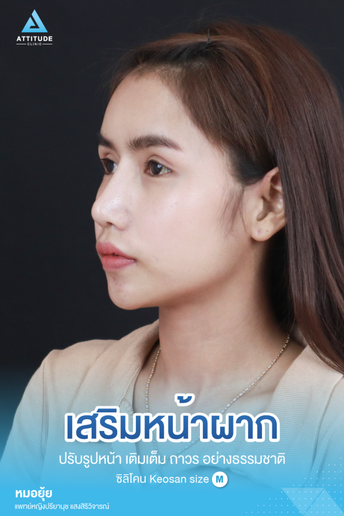 รีวิวเสริมหน้าผากผู้หญิง ด้วยซิลิโคน สำเร็จ Keosan size M แก้ปัญหาหน้าผากค่อนข้างแบน หน้าผากตรงโดยคุณหมอยุ้ย คนไข้มีปัญหาเรื่องหน้าผากค่อนข้างแบน หน้าผากตรง ทำให้รูปหน้าไม่มีส่วนเว้าส่วนโค้ง ขาดมิติ ไม่มีความละมุน