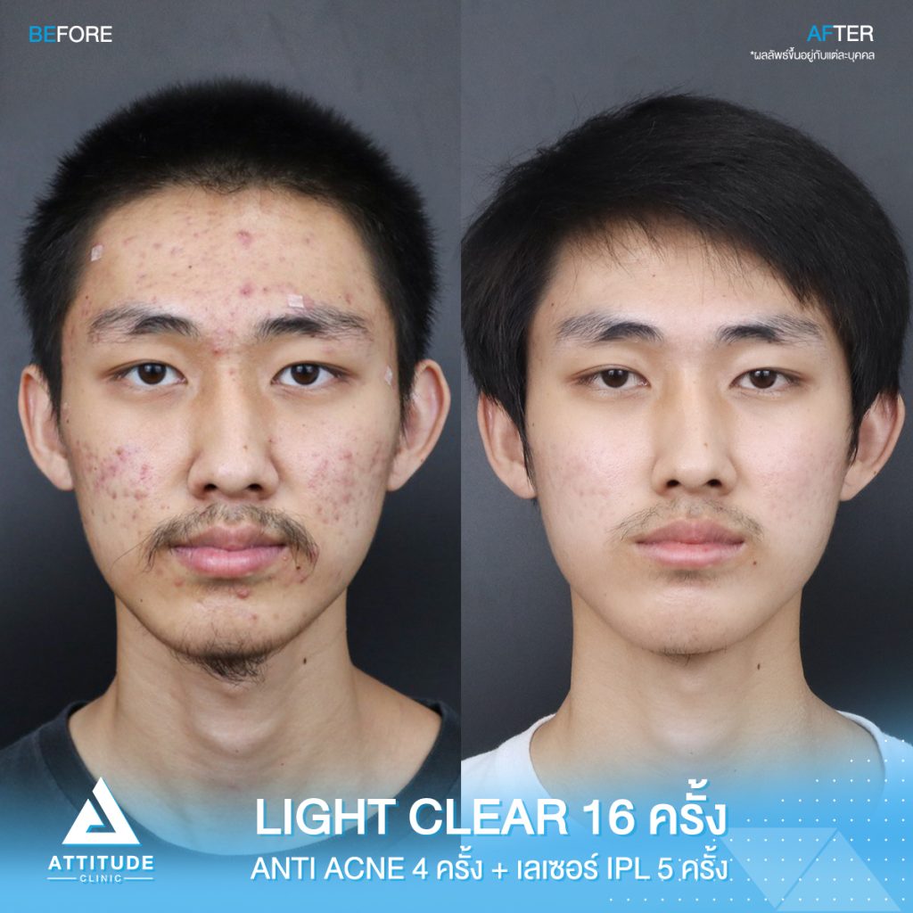 รีวิวรักษาสิวครบวงจร ด้วยการฉายแสง 7 ขั้นตอน Light Clear 10 ครั้ง Anti Acne จำนวน 4 ครั้ง และ เลเซอร์หน้าใส IPL  5 ครั้ง ของน้องกร ที่มีปัญหาสิวอุดตัน สิวอักเสบ สิวฮอร์โมน และรอยแดง รอยดำจากสิว Attitude Clinic เชียงราย เชียงใหม่ ลำปาง รีวิวเพียบ 