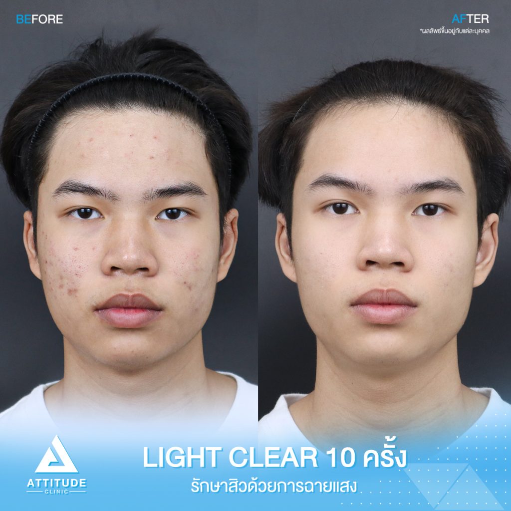 รีวิวรักษาสิวครบวงจร ด้วยการฉายแสง 7 ขั้นตอนโปรแกรม Light Clear 10 ครั้ง ของน้องกร ที่มีปัญหาสิวอุดตัน สิวอักเสบ สิวฮอร์โมน และรอยแดง รอยดำจากสิว ที่ Attitude Clinic เชียงราย เชียงใหม่ ลำปาง