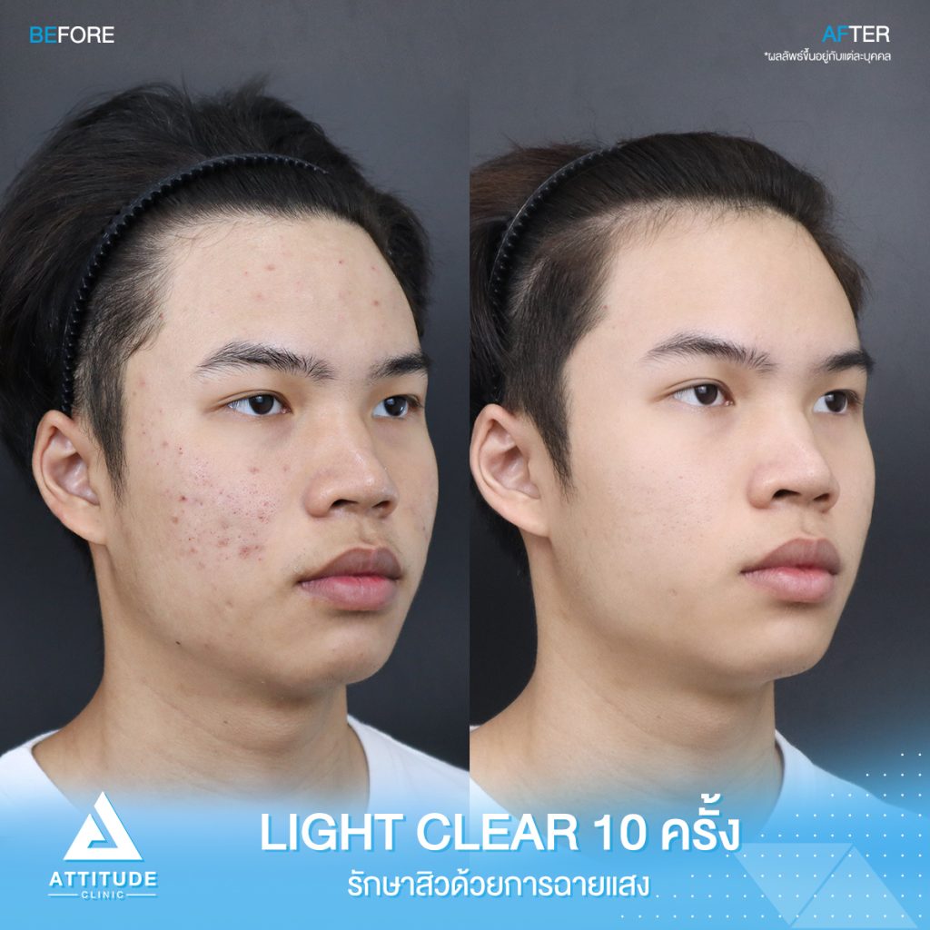 รีวิวรักษาสิวครบวงจร ด้วยการฉายแสง 7 ขั้นตอนโปรแกรม Light Clear 10 ครั้ง ของน้องกร ที่มีปัญหาสิวอุดตัน สิวอักเสบ สิวฮอร์โมน และรอยแดง รอยดำจากสิว ที่ Attitude Clinic เชียงราย เชียงใหม่ ลำปาง