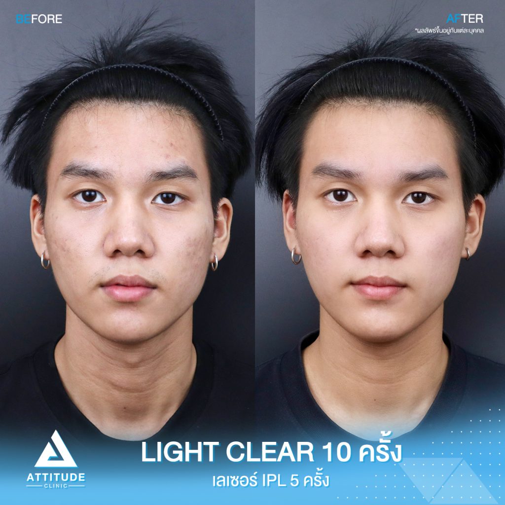 รีวิวรักษาสิวครบวงจร โปรแกรม Light Clear ด้วยการฉายแสง 7 ขั้นตอน จำนวน 10 ครั้ง และ #เลเซอร์หน้าใส Cellec V IPL จำนวน 5 ครั้ง ของคุณวิว ที่มีปัญหาสิวอุดตัน สิวอักเสบสิว สิวฮอร์โมน และรอยแดงจากสิว จนตอนนี้หน้าใส ไม่มีสิวใหม่ขึ้นแล้ว ที่ Attitude Clinic