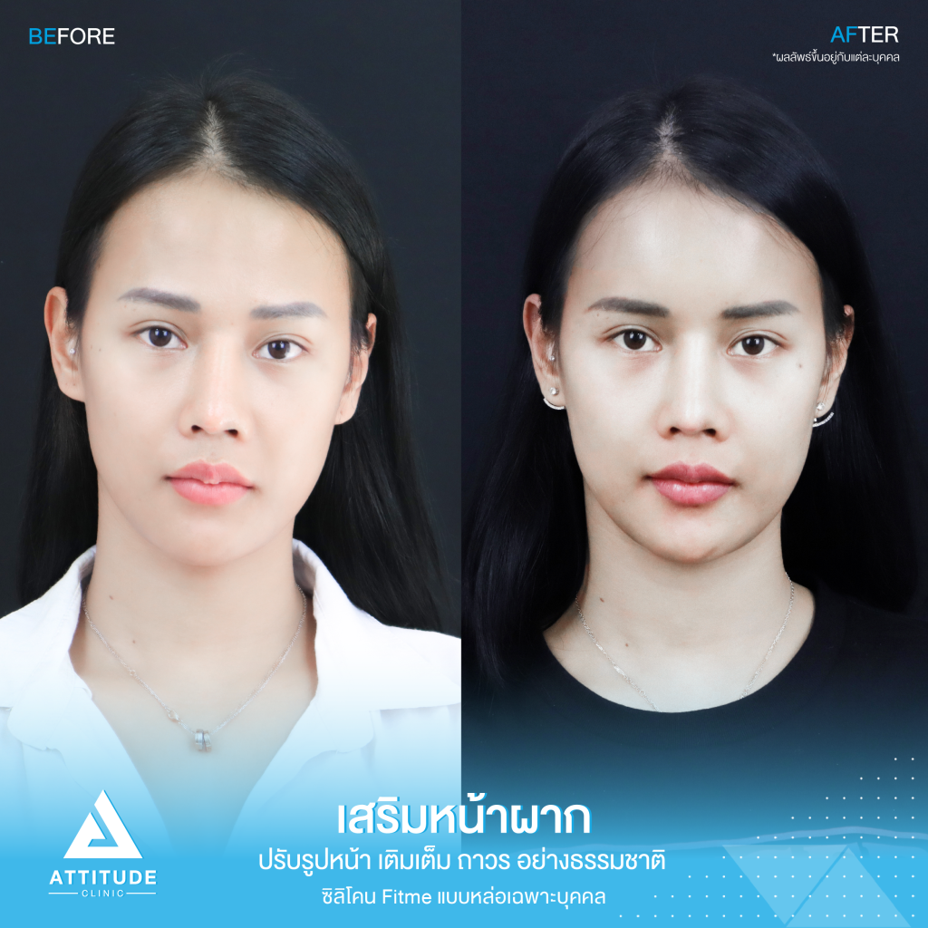 รีวิวเสริมหน้าผากผู้หญิง ด้วยซิลิโคน Fitme แบบหล่อเฉพาะบุคคล เติมเต็มหน้าผาก ปรับรูปหน้าอย่างเป็นธรรมชาติ โดยคุณหมอยุ้ย Attitude Clinic รัชดา หมออยู่ทุกวันดูแลเองทุกเคส รีวิวเพียบ