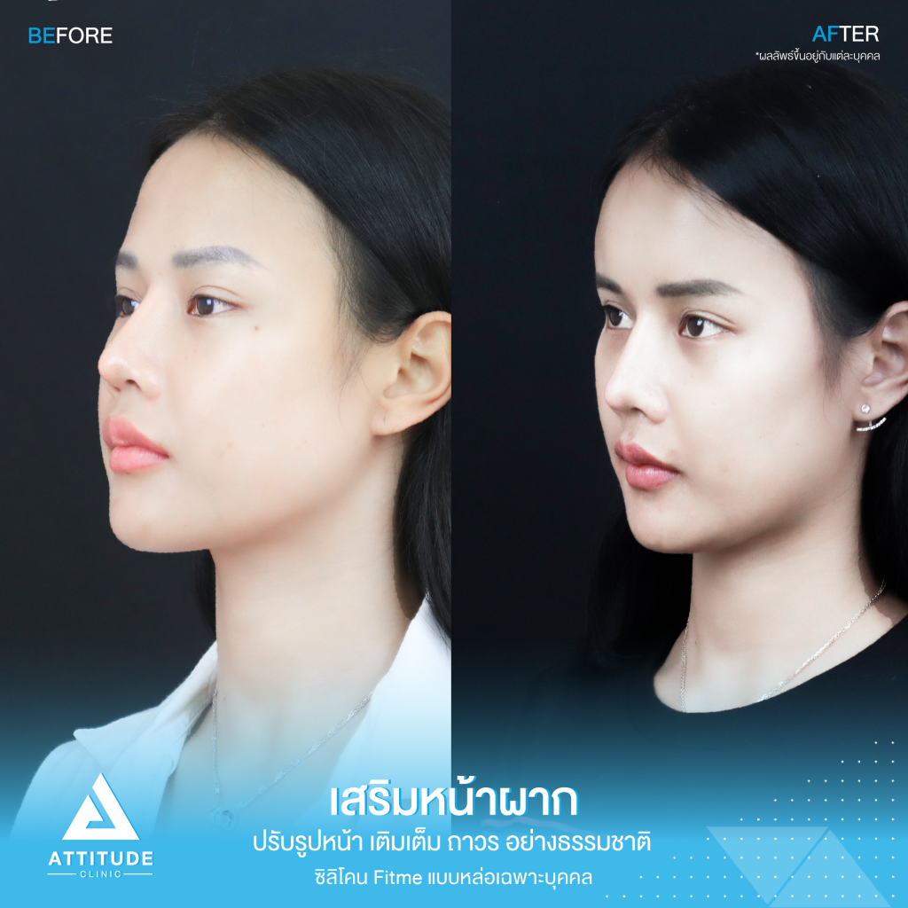 รีวิวเสริมหน้าผากผู้หญิง ด้วยซิลิโคน Fitme แบบหล่อเฉพาะบุคคล เติมเต็มหน้าผาก ปรับรูปหน้าอย่างเป็นธรรมชาติ โดยคุณหมอยุ้ย Attitude Clinic รัชดา หมออยู่ทุกวันดูแลเองทุกเคส รีวิวเพียบ