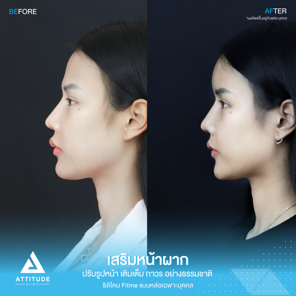 รีวิวเสริมหน้าผากผู้หญิง ด้วยซิลิโคน Fitme แบบหล่อเฉพาะบุคคล เติมเต็มหน้าผาก ปรับรูปหน้าอย่างเป็นธรรมชาติ โดยคุณหมอยุ้ย Attitude Clinic รัชดา หมออยู่ทุกวันดูแลเองทุกเคส รีวิวเพียบ