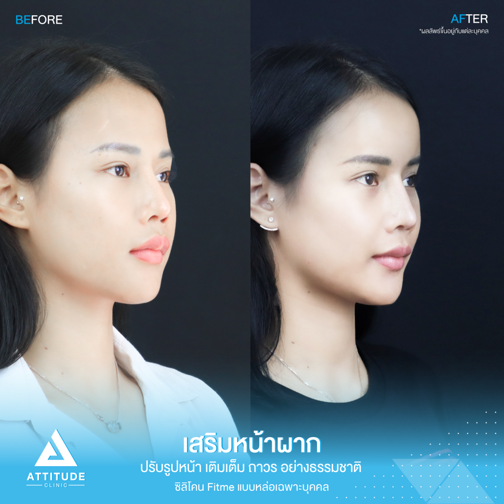 รีวิวเสริมหน้าผากผู้หญิง ด้วยซิลิโคน Fitme แบบหล่อเฉพาะบุคคล เติมเต็มหน้าผาก ปรับรูปหน้าอย่างเป็นธรรมชาติ โดยคุณหมอยุ้ย Attitude Clinic รัชดา หมออยู่ทุกวันดูแลเองทุกเคส รีวิวเพียบ
