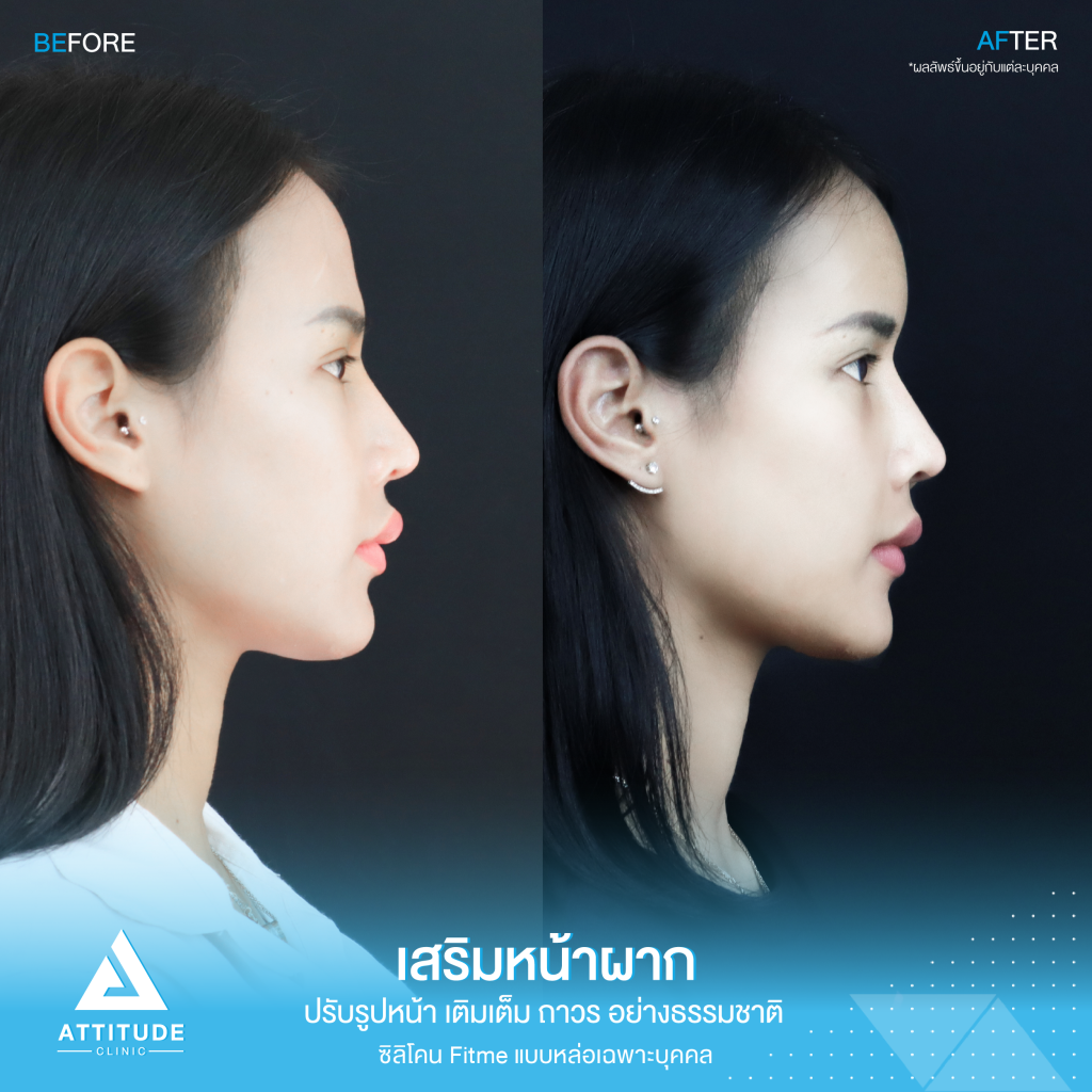 รีวิวเสริมหน้าผากผู้หญิง ด้วยซิลิโคน Fitme แบบหล่อเฉพาะบุคคล เติมเต็มหน้าผาก ปรับรูปหน้าอย่างเป็นธรรมชาติ โดยคุณหมอยุ้ย Attitude Clinic รัชดา หมออยู่ทุกวันดูแลเองทุกเคส รีวิวเพียบ