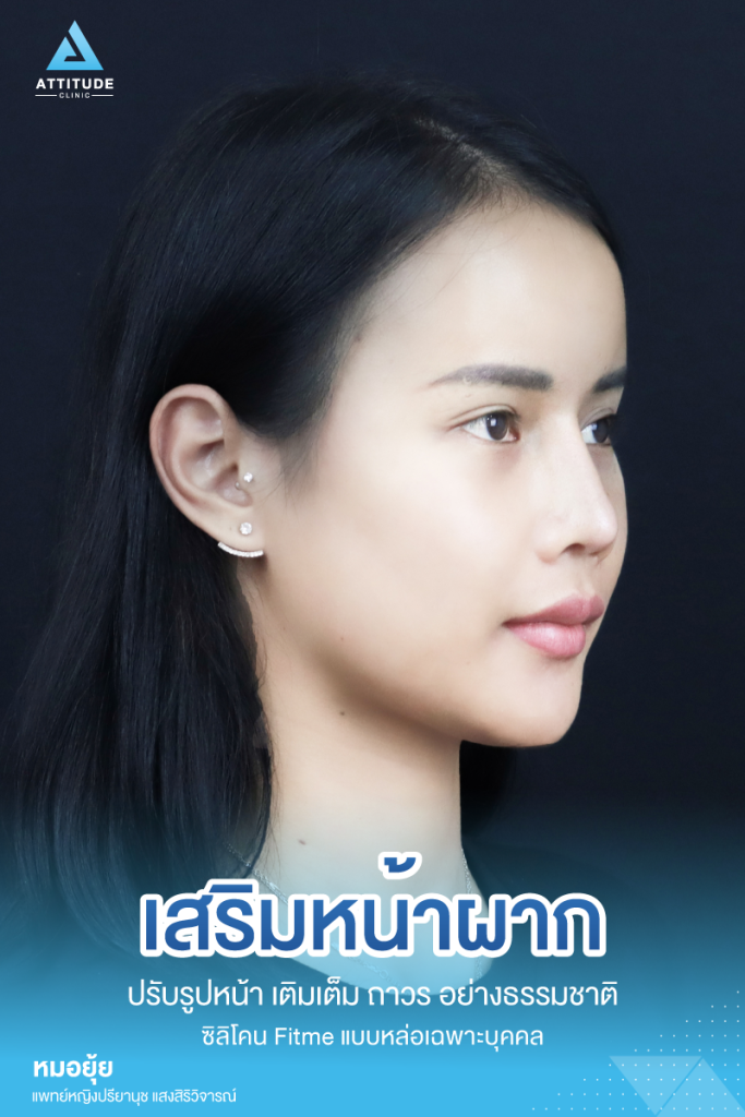 รีวิวเสริมหน้าผากผู้หญิง ด้วยซิลิโคน Fitme แบบหล่อเฉพาะบุคคล เติมเต็มหน้าผาก ปรับรูปหน้าอย่างเป็นธรรมชาติ โดยคุณหมอยุ้ย Attitude Clinic รัชดา หมออยู่ทุกวันดูแลเองทุกเคส รีวิวเพียบ