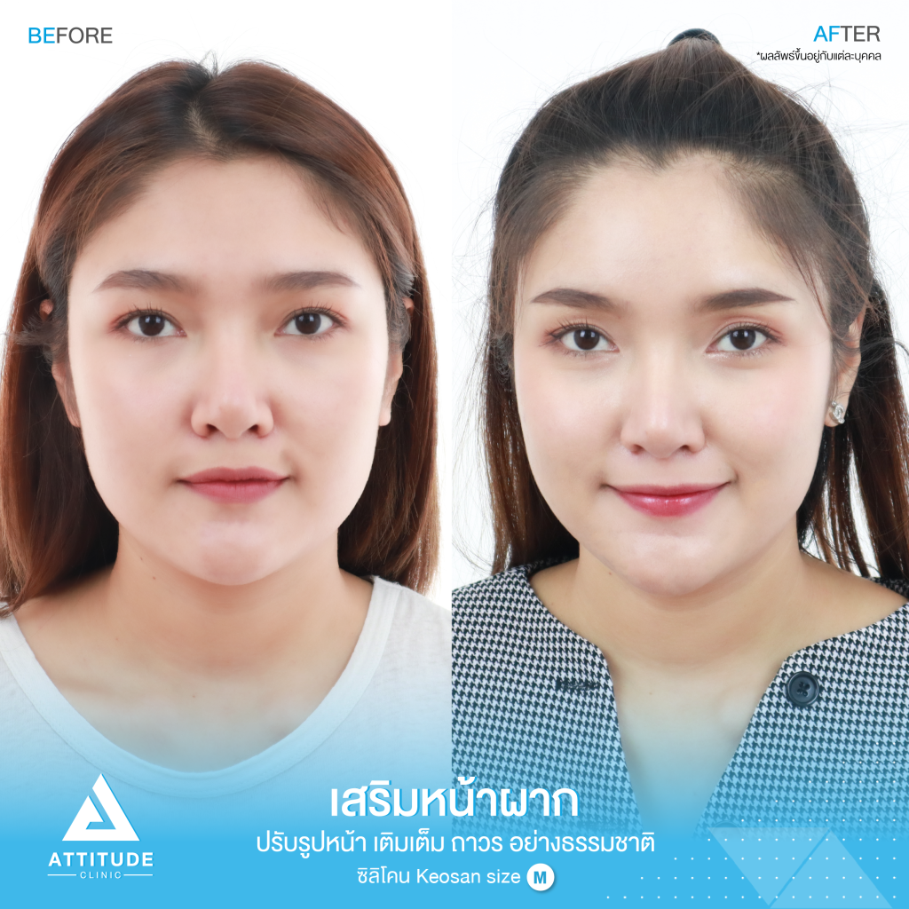 รีวิวเสริมหน้าผากผู้หญิง ด้วยซิลิโคน สำเร็จ Keosan size M แก้ปัญหาหน้าผากแบน ให้สวยมีมิติ โดยคุณหมอยุ้ย Attitude Clinic รัชดา หมออยู่ทุกวัน ทำเองทุกเคส รีวิวเยอะมาก