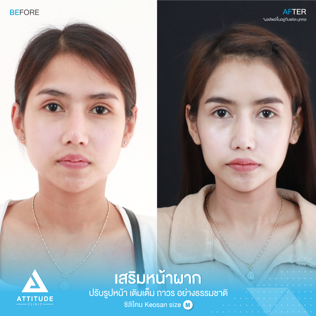 รีวิวเสริมหน้าผากผู้หญิง ด้วยซิลิโคน สำเร็จ Keosan size M แก้ปัญหาหน้าผากค่อนข้างแบน หน้าผากตรงโดยคุณหมอยุ้ย คนไข้มีปัญหาเรื่องหน้าผากค่อนข้างแบน หน้าผากตรง ทำให้รูปหน้าไม่มีส่วนเว้าส่วนโค้ง ขาดมิติ ไม่มีความละมุน