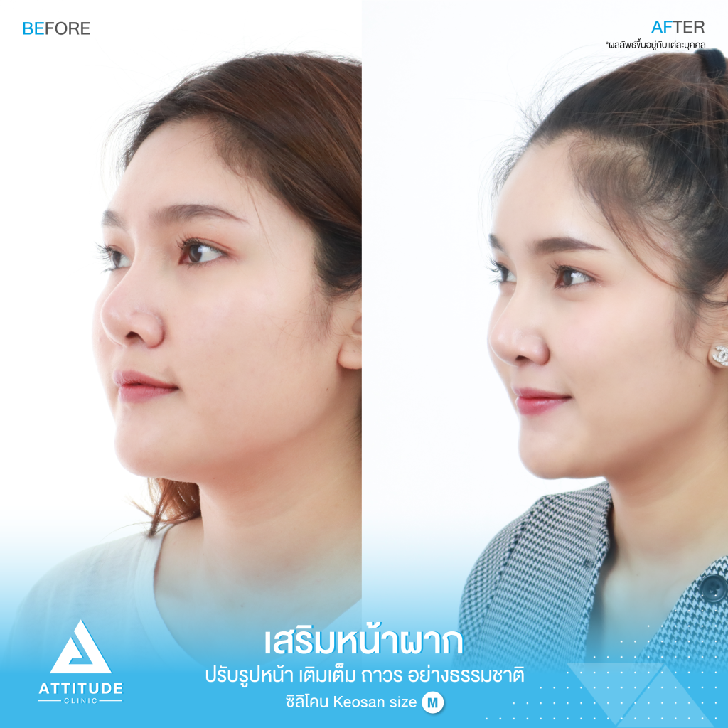 รีวิวเสริมหน้าผากผู้หญิง ด้วยซิลิโคน สำเร็จ Keosan size M แก้ปัญหาหน้าผากแบน ให้สวยมีมิติ โดยคุณหมอยุ้ย Attitude Clinic รัชดา หมออยู่ทุกวัน ทำเองทุกเคส รีวิวเยอะมาก 