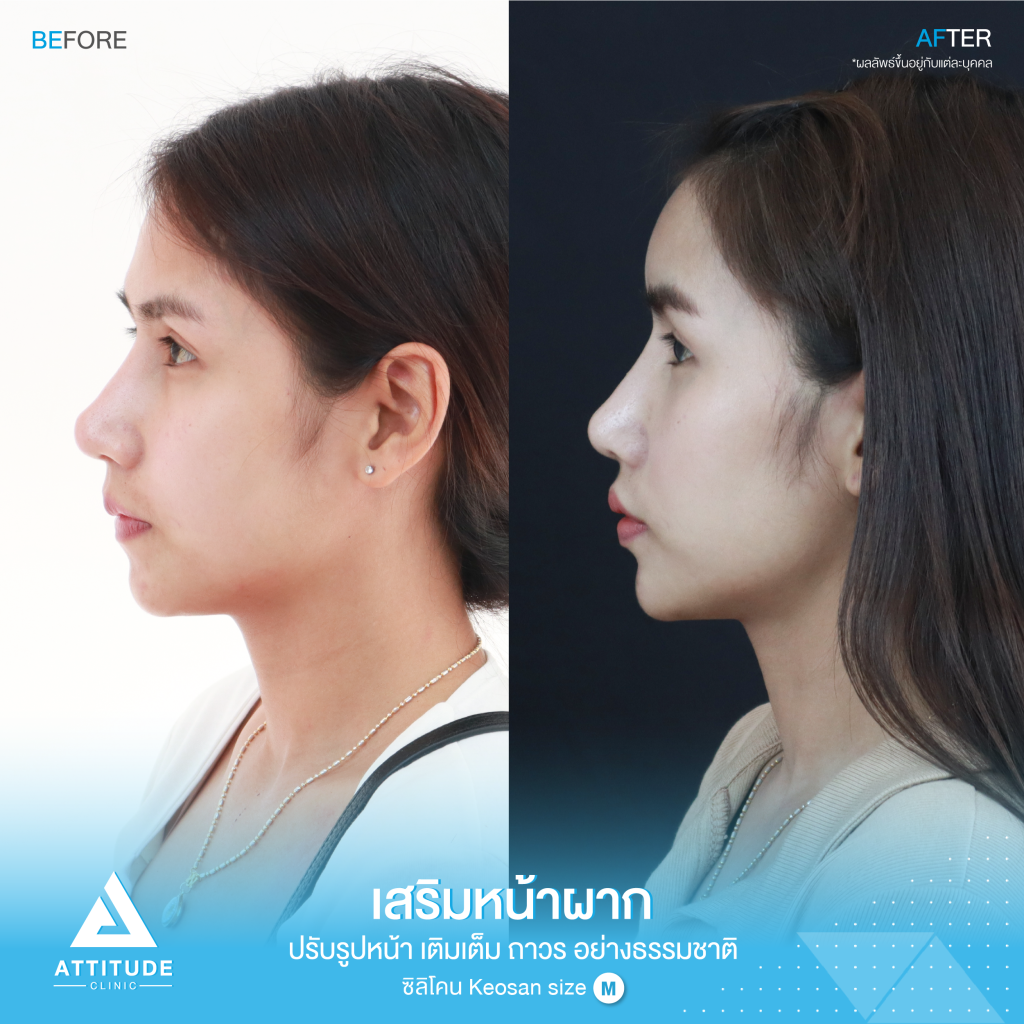 รีวิวเสริมหน้าผากผู้หญิง ด้วยซิลิโคน สำเร็จ Keosan size M แก้ปัญหาหน้าผากค่อนข้างแบน หน้าผากตรงโดยคุณหมอยุ้ย คนไข้มีปัญหาเรื่องหน้าผากค่อนข้างแบน หน้าผากตรง ทำให้รูปหน้าไม่มีส่วนเว้าส่วนโค้ง ขาดมิติ ไม่มีความละมุน