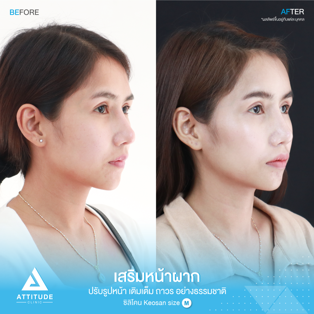 รีวิวเสริมหน้าผากผู้หญิง ด้วยซิลิโคน สำเร็จ Keosan size M แก้ปัญหาหน้าผากแบน ให้สวยมีมิติ โดยคุณหมอยุ้ย Attitude Clinic รัชดา หมออยู่ทุกวัน ทำเองทุกเคส รีวิวเยอะมาก 