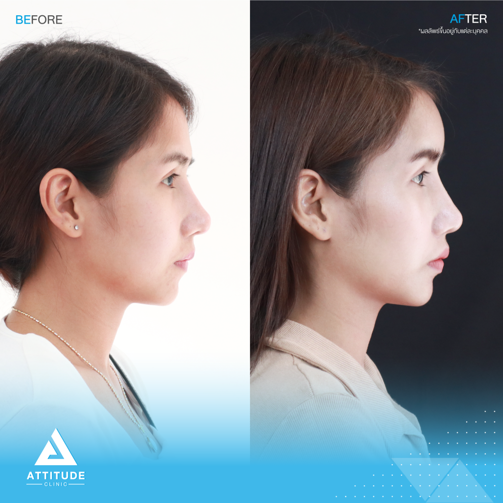 รีวิวเสริมหน้าผากผู้หญิง ด้วยซิลิโคน สำเร็จ Keosan size M แก้ปัญหาหน้าผากค่อนข้างแบน หน้าผากตรงโดยคุณหมอยุ้ย คนไข้มีปัญหาเรื่องหน้าผากค่อนข้างแบน หน้าผากตรง ทำให้รูปหน้าไม่มีส่วนเว้าส่วนโค้ง ขาดมิติ ไม่มีความละมุน