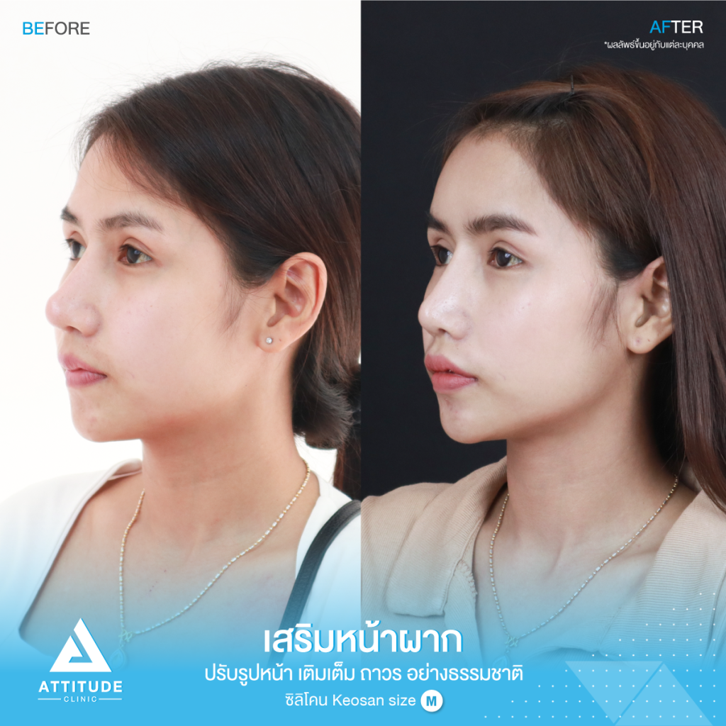 รีวิวเสริมหน้าผากผู้หญิง ด้วยซิลิโคน สำเร็จ Keosan size M แก้ปัญหาหน้าผากค่อนข้างแบน หน้าผากตรงโดยคุณหมอยุ้ย คนไข้มีปัญหาเรื่องหน้าผากค่อนข้างแบน หน้าผากตรง ทำให้รูปหน้าไม่มีส่วนเว้าส่วนโค้ง ขาดมิติ ไม่มีความละมุน