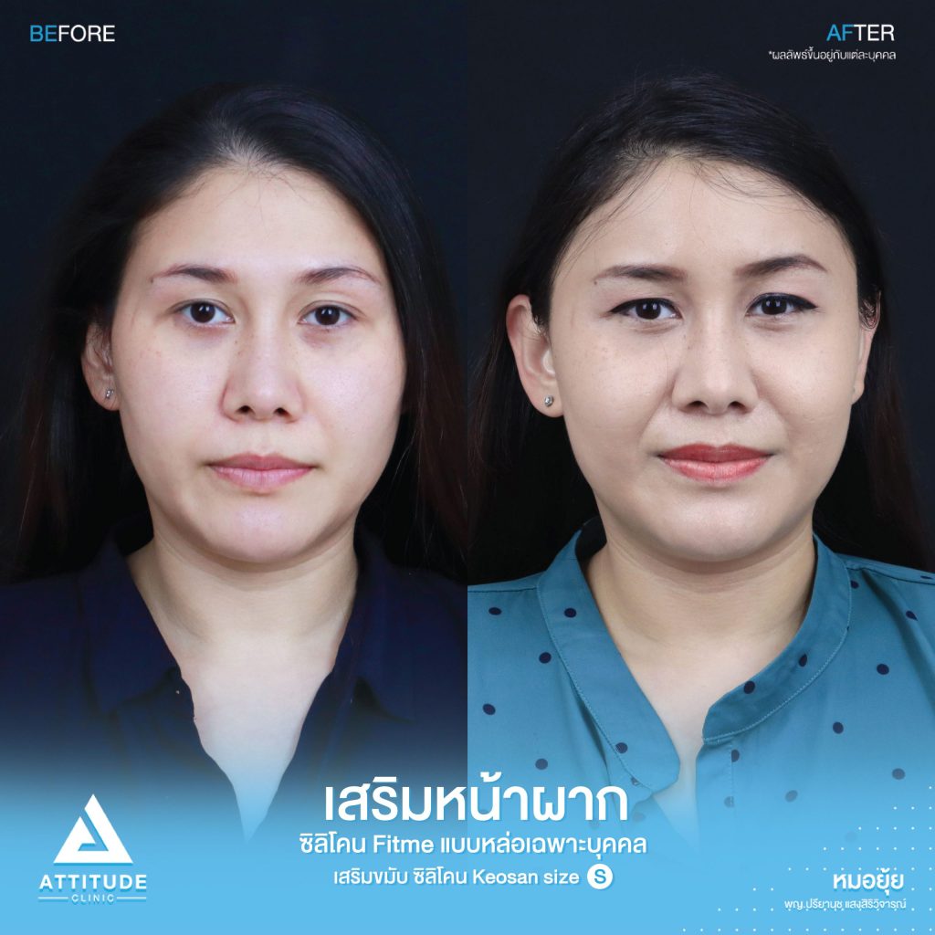รีวิวเสริมหน้าผากคุณฟ้า ด้วยซิลิโคน Fitme แบบหล่อเฉพาะบุคคล และเสริมขมับด้วยซิลิโคน Keosan size S เติมเต็มปรับโหวงเฮ้งหน้าผากขมับ ลดอายุ เพิ่มความละมุนโดยคุณหมอยุ้ย Attitude Clinic รัชดา