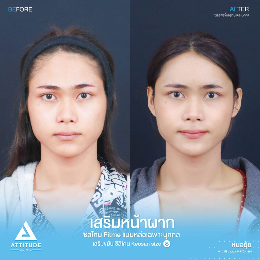 รีวิวเสริมหน้าผากคุณปัง ด้วยซิลิโคน Fitme แบบหล่อเฉพาะบุคคล และเสริมขมับด้วยซิลิโคน Keosan size S แก้ไขหน้าผากบางนูนยุบตัวลง โหนกคิ้วสูง ปรับรูปหน้าใหดูละมุน โดยคุณหมอยุ้ย Attitude Clinic รัชดา