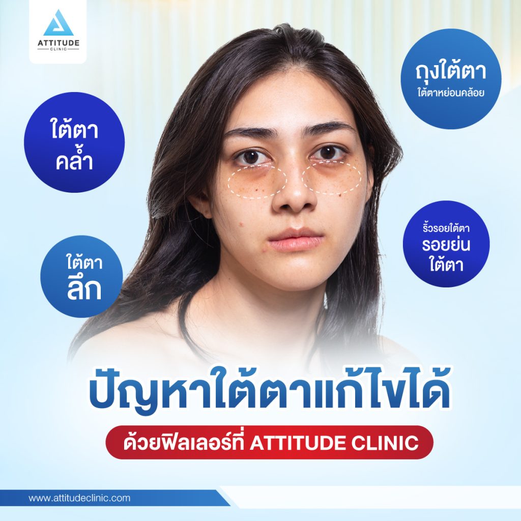 ปัญหาใต้ตาแก้ไขได้ด้วยฟิลเลอร์ที่ Attitude Clinic อย่างที่เราทราบกันดีว่า บริเวณรอบดวงตาเป็นจุดที่บอบบางมาก เมื่อเราแสดงอารมณ์สีหน้าท่าทาง กรรมพันธุ์ พฤติกรรมการใช้ชีวิต หรืออายุที่เพิ่มมากขึ้น จะส่งผลโดยตรงต่อดวงตา ทั้งปัญหารอยคล้ำ ถุงใต้ตา ปัญหาเหล่านี้สามารถแก้ไขได้ ด้วยการฉีดฟิลเลอร์ที่ Attitude Clinic ครับ