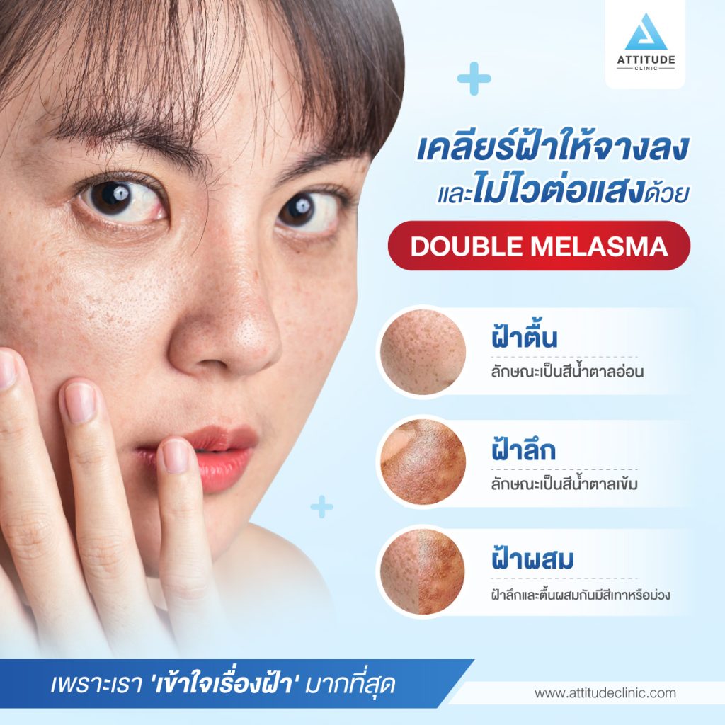 เพราะเรา 'เข้าใจเรื่องฝ้า' มากที่สุด เคลียร์ฝ้าให้จางลงและไม่ไวต่อแสงด้วย Double Melasma ที่ Attitude Clinic เชียงราย เชียงใหม่ ลำปาง รีวิวเยอะที่สุด รักษาฝ้าอย่างตรงจุด