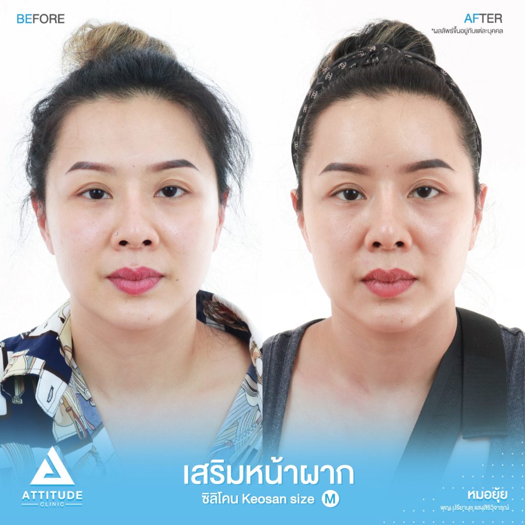 รีวิวเสริมหน้าผากคุณจิว ด้วยซิลิโคนสำเร็จ เกาหลี Keosan size M เติมเต็มหน้าผากที่ยุบตัวให้เต็ม โค้งมนอย่างธรรมชาติ โดยคุณหมอยุ้ย