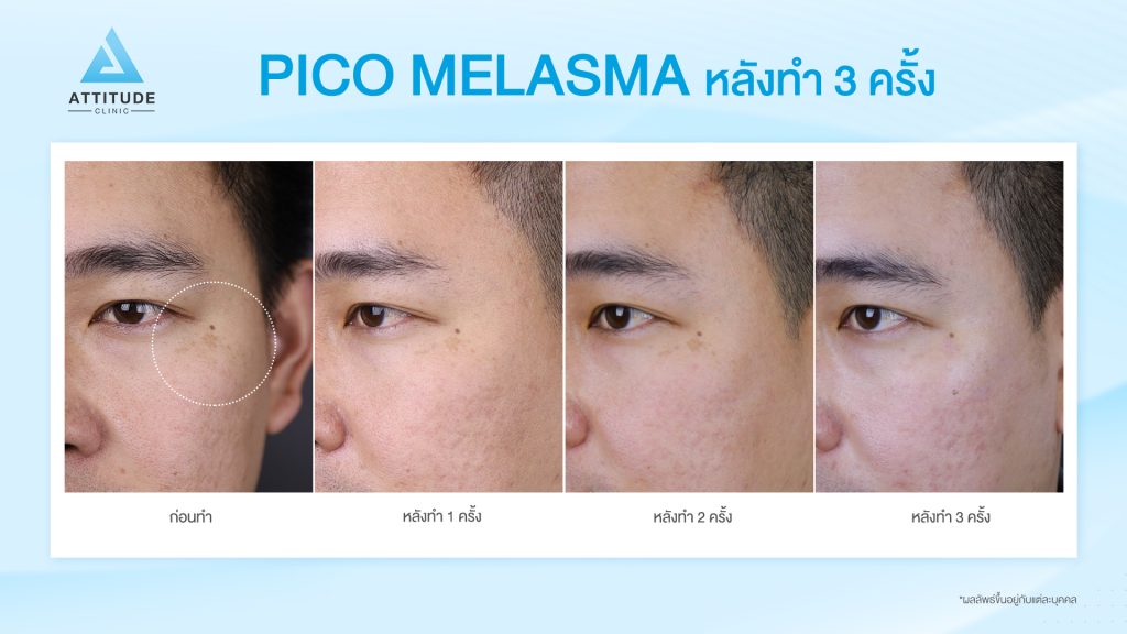  รีวิวรักษาฝ้า จำนวน 3 ครั้ง ด้วยเครื่องเลเซอร์ ???????? ??? นวัตกรรม Picosecond Laser ใหม่ล่าสุดมาตรฐาน ??US FDA ส่งพลังงานความเร็ว 1 ต่อล้านล้านวินาที สามารถยิงเม็ดสีแตกละเอียด กว่าเลเซอร์รุ่นเก่าๆ ถึง 1,000 เท่า 